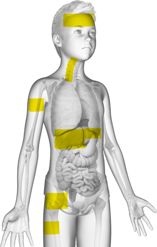 HLH patient graphic with symptoms